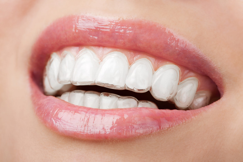Close-up of a mouth wearing Invisalign clear aligners for teeth straightening