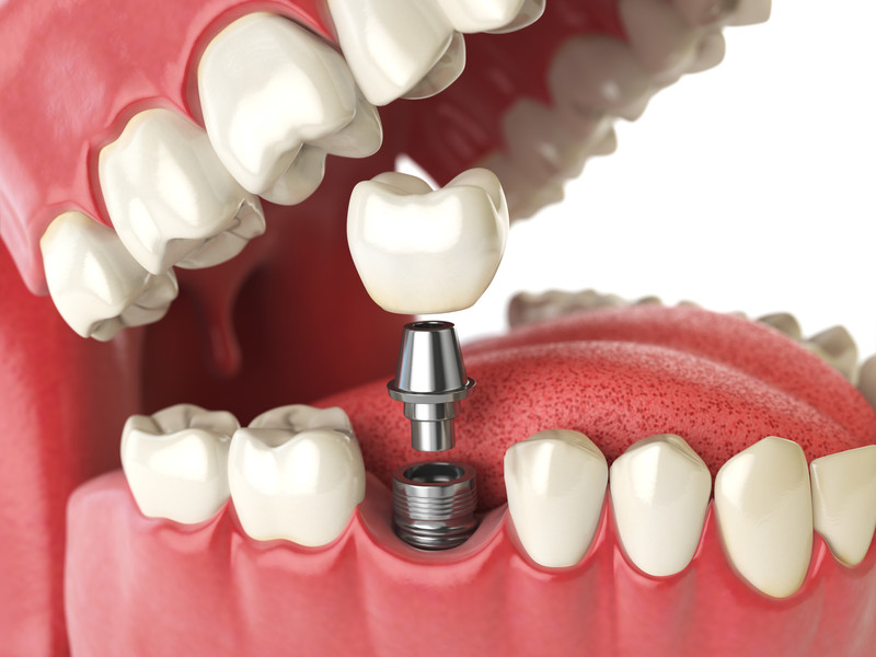 Model of a single dental implant used to replace a missing tooth Model of a single dental implant used to replace a missing tooth