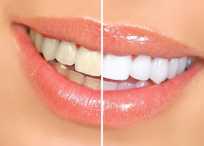 Teeth whitening results showing before and after transformation